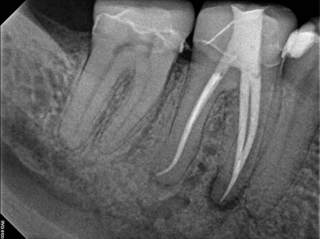 The apex locator is so accurate that precise root lengths can be determined without the need for additional interoperative x-rays in most cases. Although the amount of radiation with digital dental radiography is minimal, most procedures can be completed with only two radiographs, one before and one after. In most cases, the apex locator allows us to complete treatment without additional "check films".