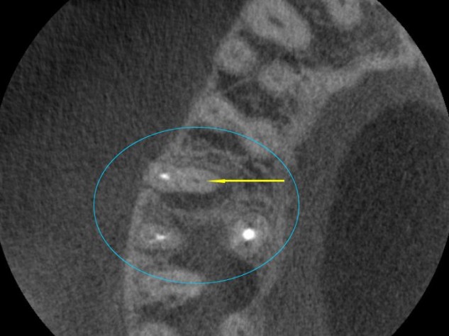 This is an axial CBCT “slice” looking at the upper right teeth. The view is as if we were standing on the bottom teeth, looking up at the top teeth, and this is a cross – section (think of looking straight down on a cut tree stump). We are looking at a previous root canal therapy that didn’t work and requires retreatment to save the tooth. The white dots are the root canal fillings. The black dot is a canal that was not treated the first time (so it is still full of bacteria) and prevented this incomplete root canal treatment from working. With CBCT, we can see this view for the first time. This offers a significant improvement in our ability diagnose and correct the problem of “missed canals” on retreatments. This view is beneficial for non-retreatment cases as well, to know how many canals are in a tooth, and their location prior to initiating root canal therapy. Teeth have a variable number of canals and all of them need to be treated for the root canal therapy to be successful.