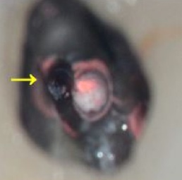 This is a photo of inside a tooth, through the surgical operating microscope. The photo demonstrates where a canal was cleaned and filled (pink), but where another canal was missed. Without a microscope, it would have been nearly impossible to find, and subsequently treat this canal, and the root canal therapy would have ultimately failed. Thanks to the microscope, this difficult case became straight forward and successful.