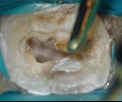 This is a picture of an ultrasonic tip conservatively removing tooth structure that is required to treat the root canal. In the same view using a dental handpiece (drill), the head of the handpiece can obscure the doctor’s view, making it more difficult to remove small, precise amounts of tooth structure. It is important for the long term prognosis to avoid unnecessarily removing any additional tooth structure.