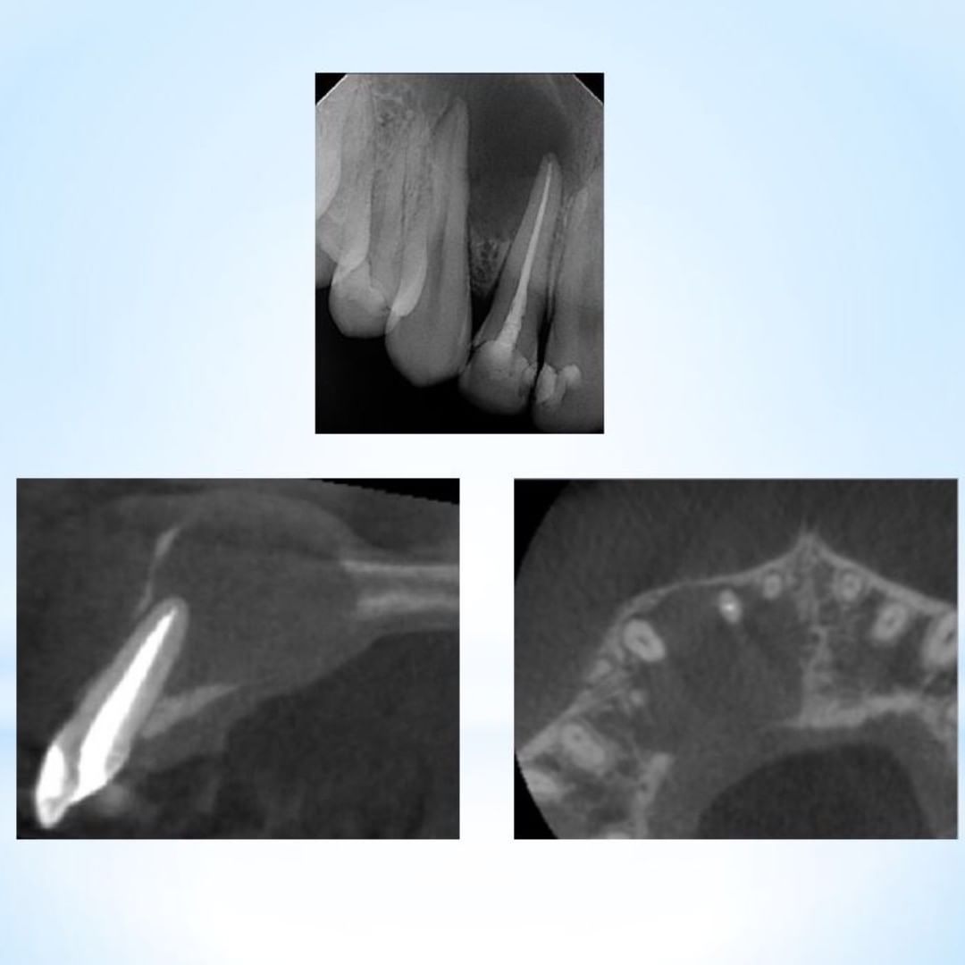 #7 Previous RCT, very large radiolucent finding. Displaced root?  Patient was swollen and experiencing discomfort.  Adjacent teeth had normal responses to cold. .
What would you do?
.
A) Retreat 7
B) RCT adjacent teeth
C) Apical surgery
D) Refer to OS for extraction / biopsy?
E) Something else? What?