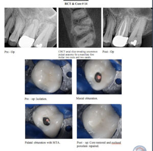 Porcelain_repair_for_a_PFM_crown