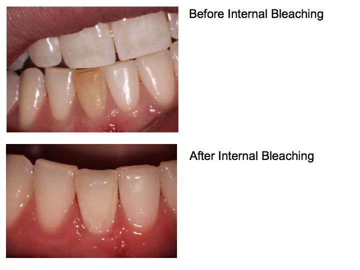 Internal Bleaching