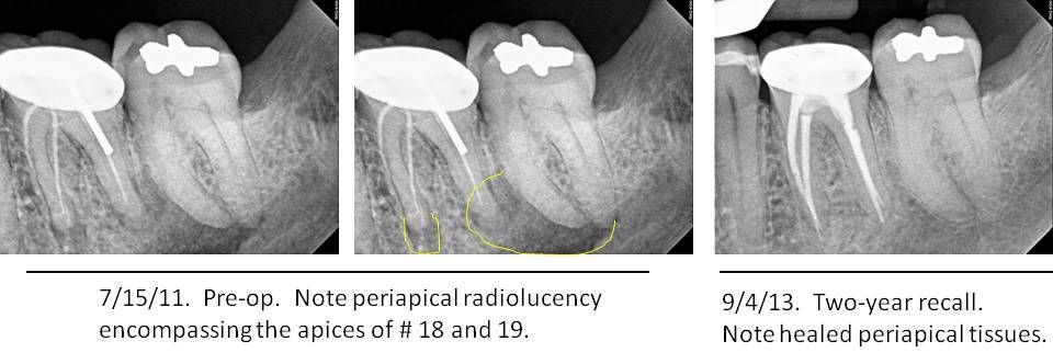 Conservative Endodontic Diagnosis