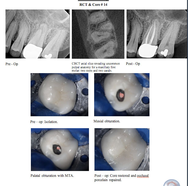 Porcelain Repair/Esthetic Restoration of Endodontically Accessed Crowns