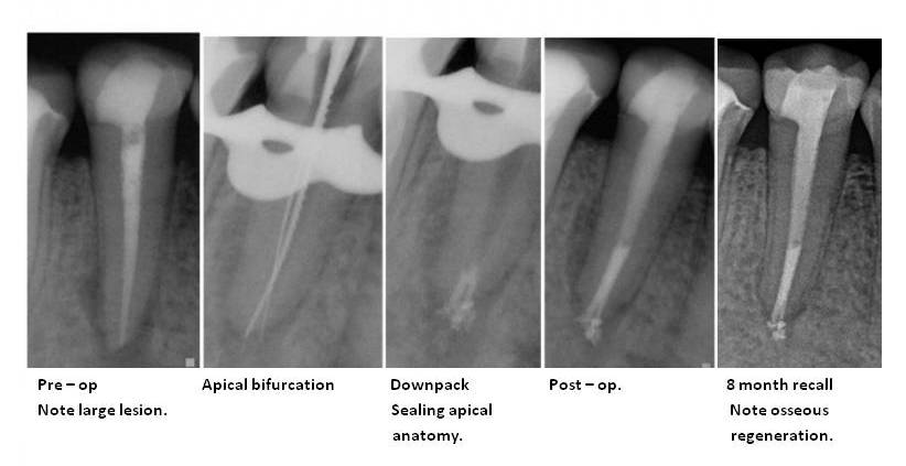 Root Canal Retreatment