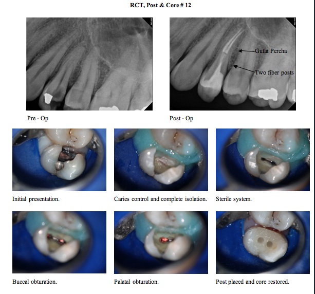 Core Restoration / Buildups and Post Cementation