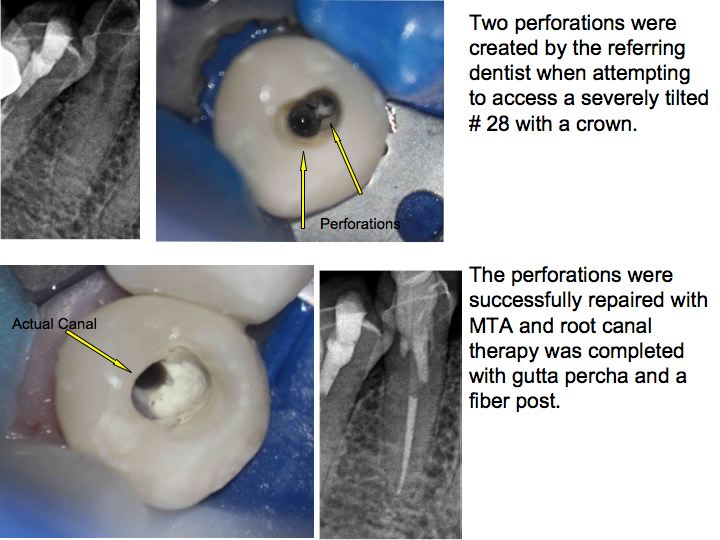 Perforation Repair