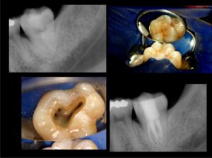 root_canal_therapy