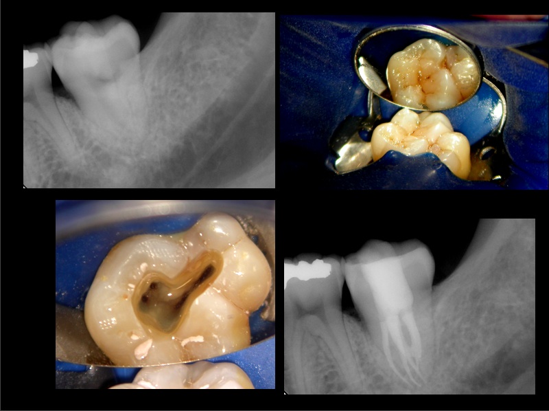 Root Canal Therapy